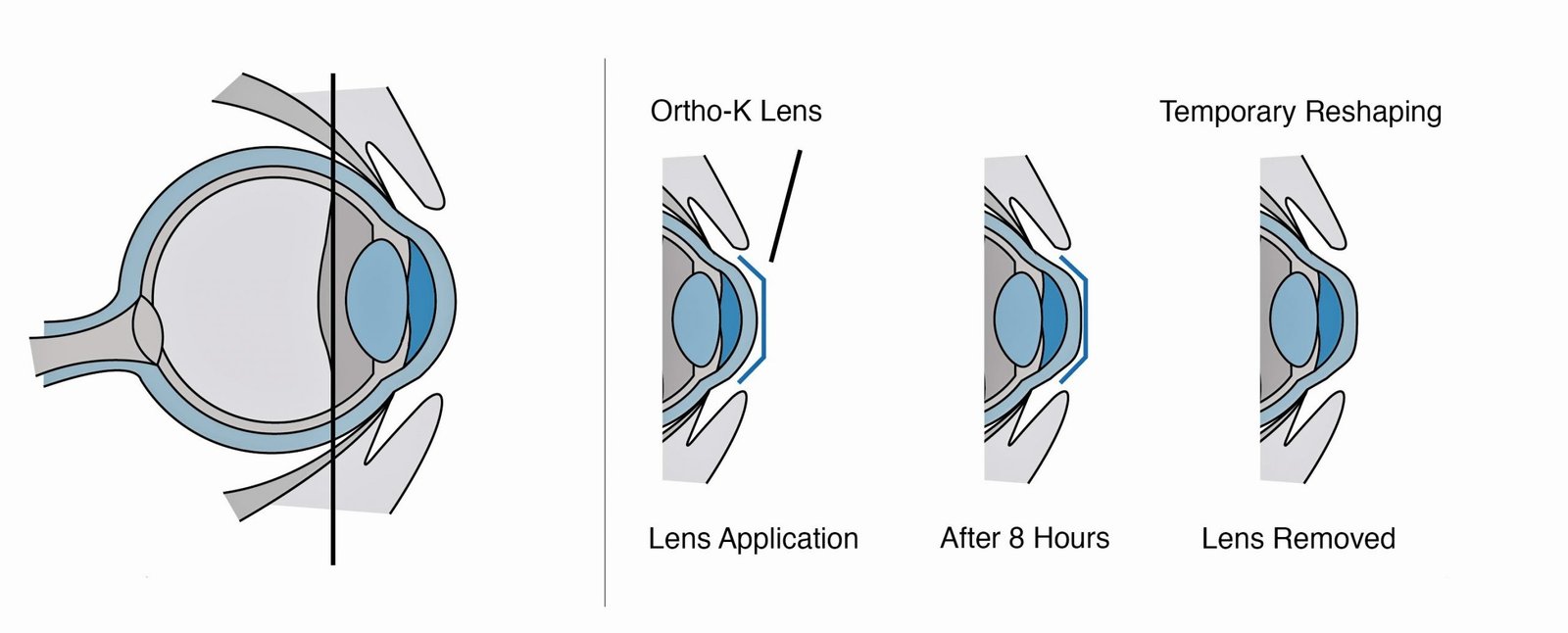 What Is Orthokeratology 2 Effective Alternatives To Wearing Glasses What Is Orthokeratology 2 Effective Alternatives To Wearing Glasses